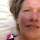 Ansigtløft med akupunktur hos Apunkt